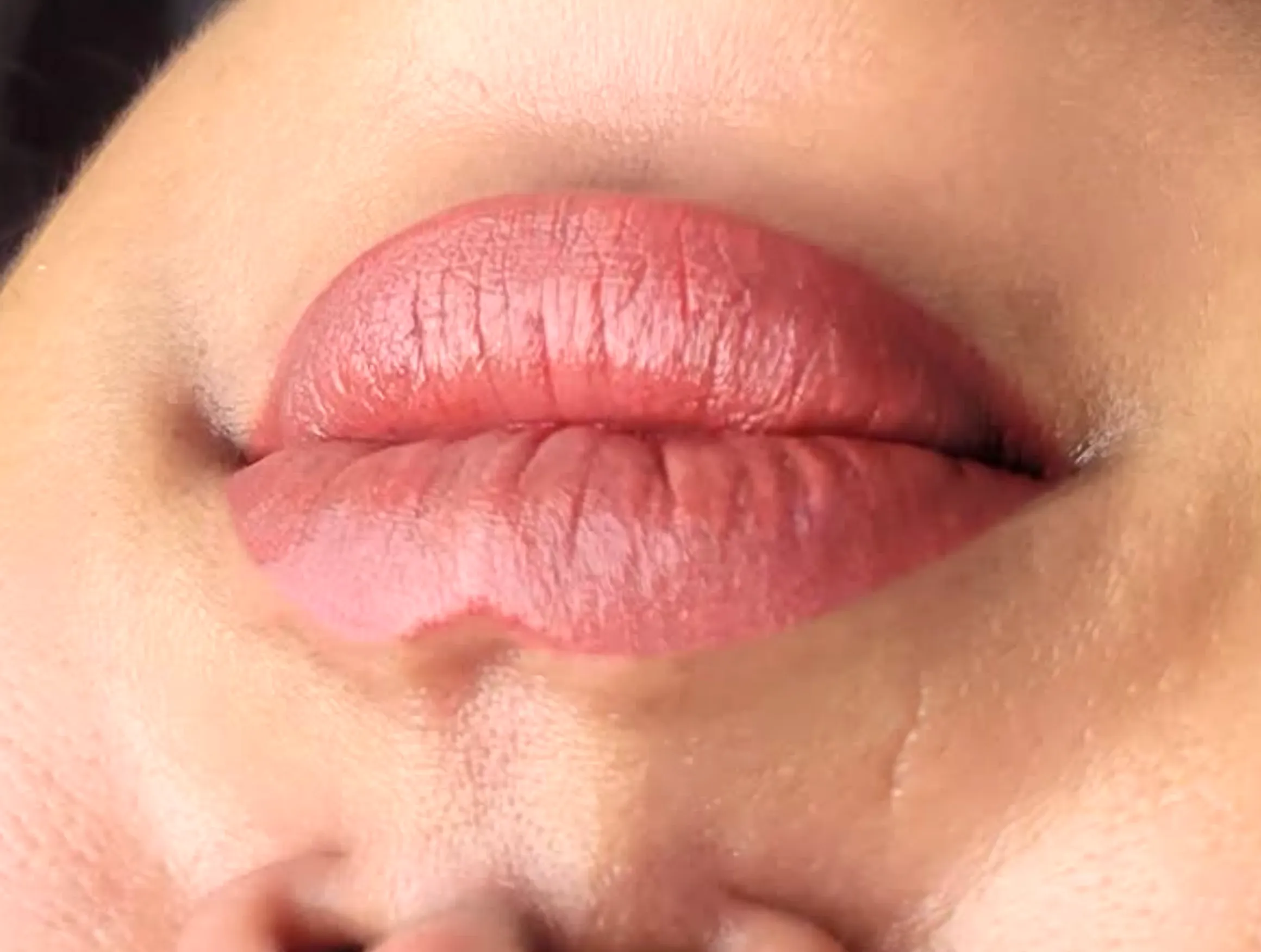 lip blush after lip filler