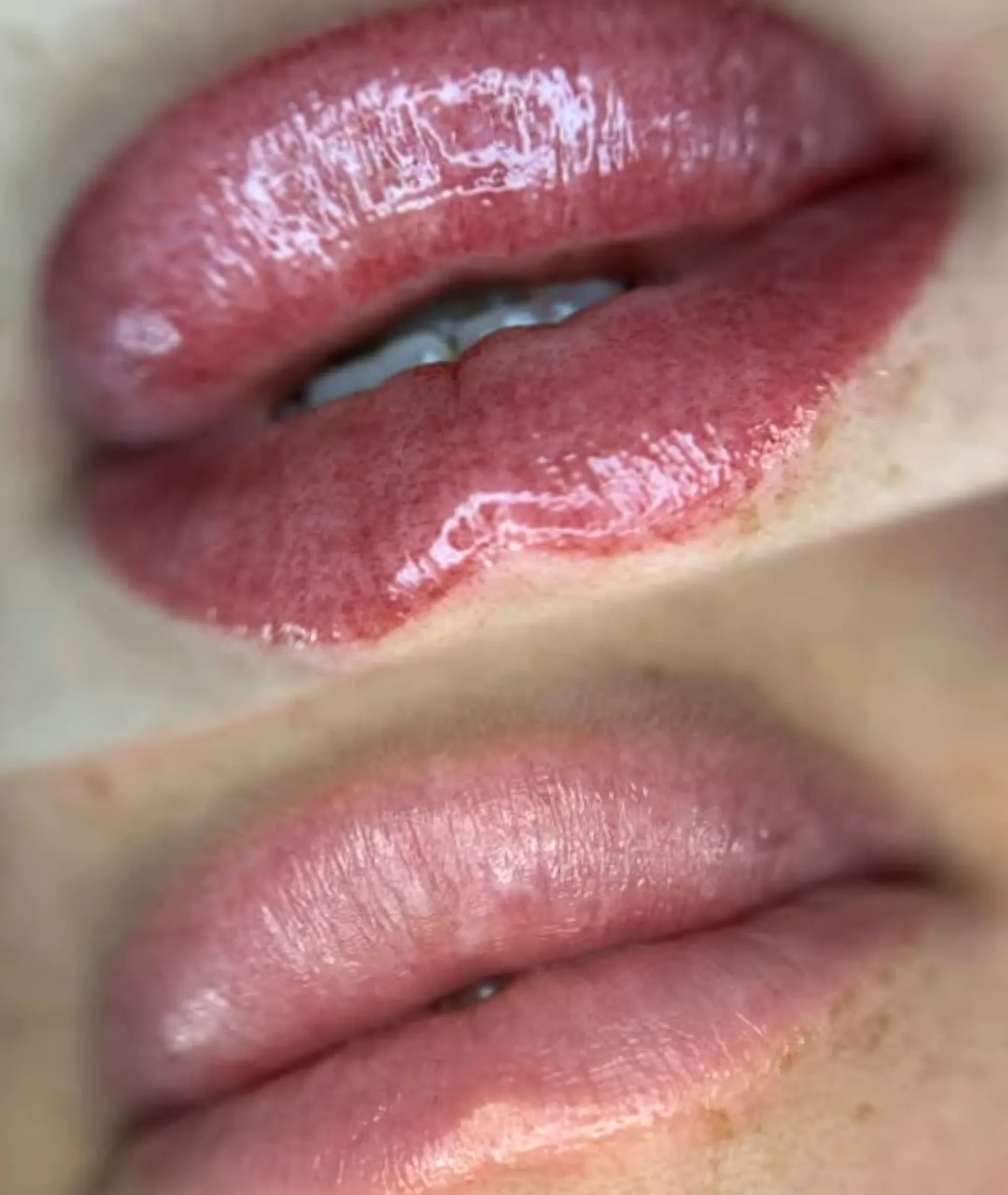 cosmetic tattoo removal Melbourne