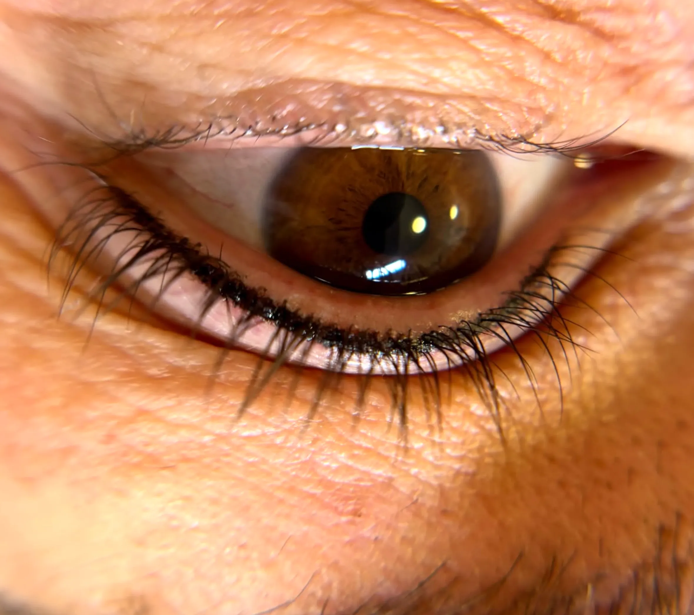 saline vs laser brow removal